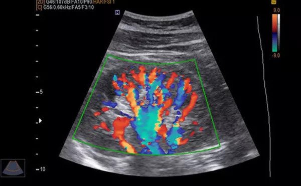 doppler test for legs results