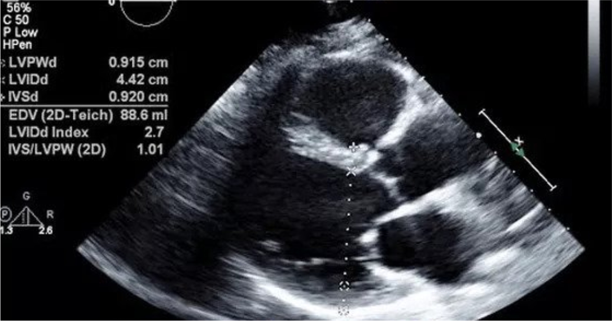 2d Echo Test For Heart In Hindi