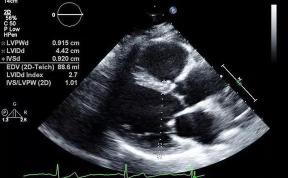 echocardiogram results