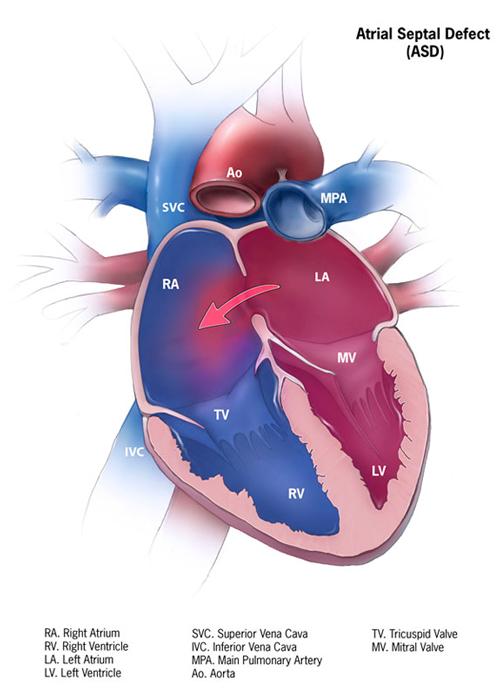 ASD Closure Device | ASD Catheter | ASD Treatment