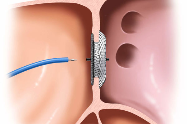 Device Closure Procedure, ASD, VSD, PDA