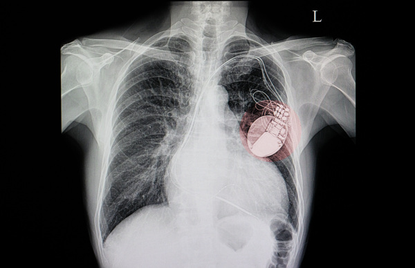 pacemaker-implantation-cost-temporary-pacemaker-implantation