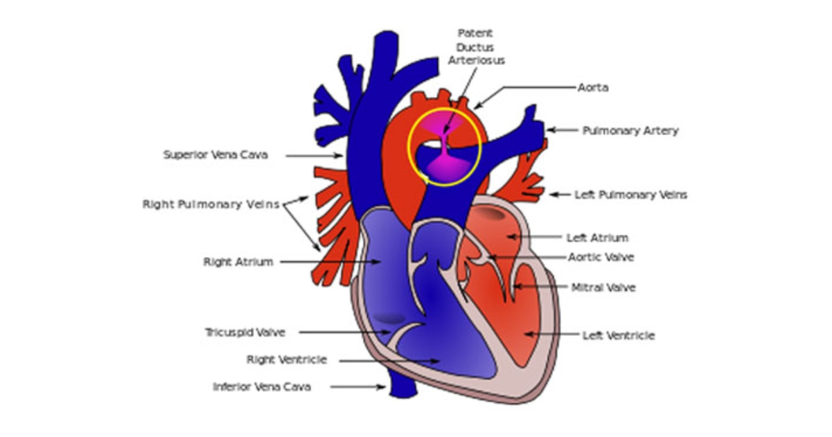 PDA Device Closure | PDA Heart Surgery | PDA Heart Treatment